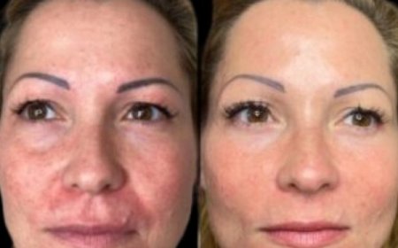 Explore True Renewal via Profhilo at the Best Aesthetic Clinics in dubai