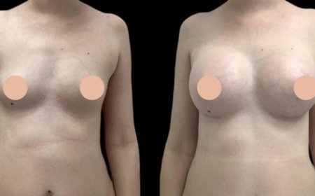 Breast Augmentation in Dubai: What Makes It World-Class?