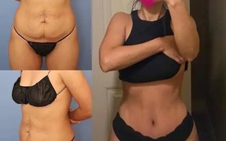 The Impact of Tummy Tuck in Dubai on Posture and Strength