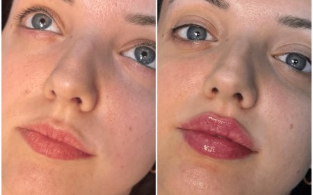 Dermal Fillers in Dubai: Best Options for Contouring the Face