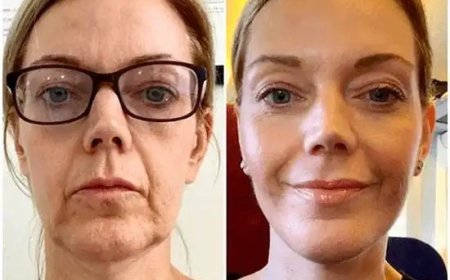 Channel Glow through Profhilo and Best Doctors in dubai