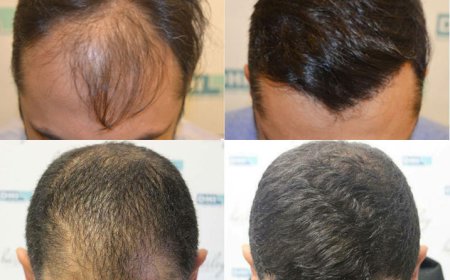 Restore Your Confidence with a Hair Transplant in Bhubaneswar