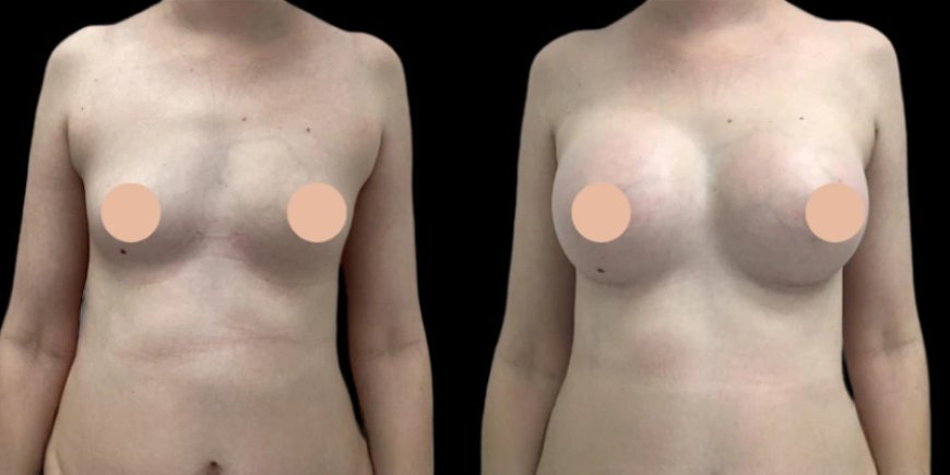 Breast Augmentation in Dubai: What Makes It World-Class?