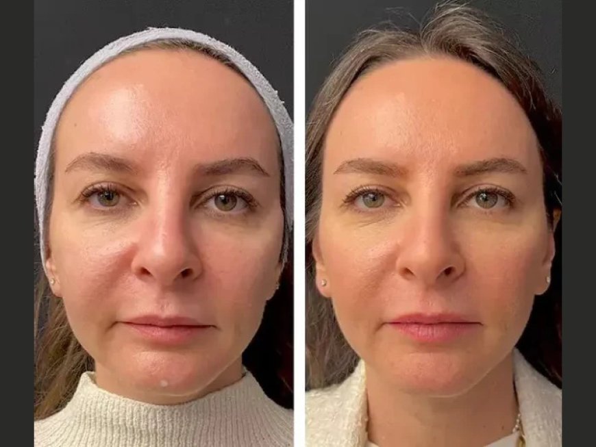 Treating Hair Loss with Mesotherapy: Insights from the Best Plastic Surgeons in Dubai