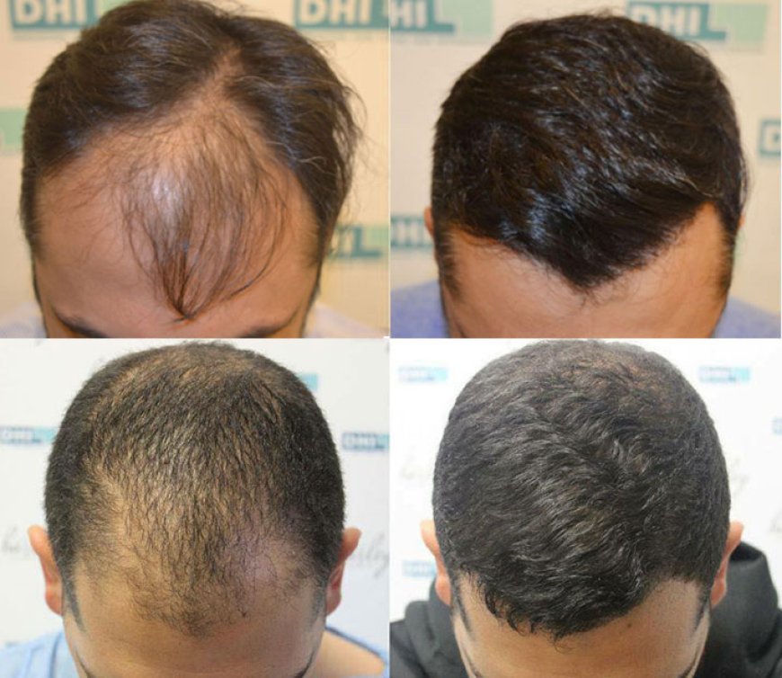 Restore Your Confidence with a Hair Transplant in Bhubaneswar