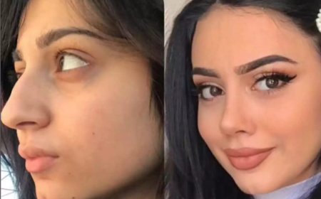 Types of Nose Surgery in Dubai: Cosmetic, Functional, or Both?