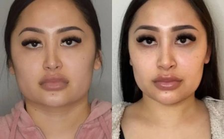 Buccal Fat Removal and Facial Harmony: Expertise from the Best Buccal Fat Removal Surgeon in Dubai