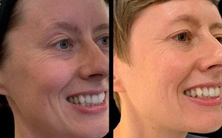 Enrich Features via Profhilo by the Best Plastic Surgeon in dubai