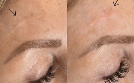 How to Master Scar Camouflage Tattooing and PMU Apprenticeship?