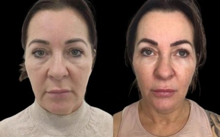 Best Plastic Surgeon in Dubai Offering Non-Surgical Face Rejuvenation with Profhilo