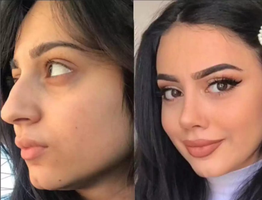 Types of Nose Surgery in Dubai: Cosmetic, Functional, or Both?