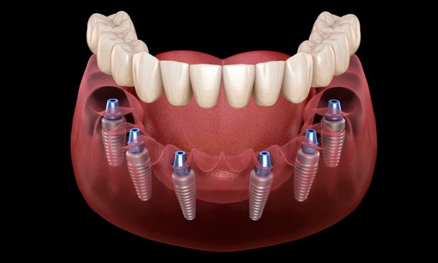 Wat zijn de werkelijke All-on-4 kosten? Een volledige gids voor patiënten
