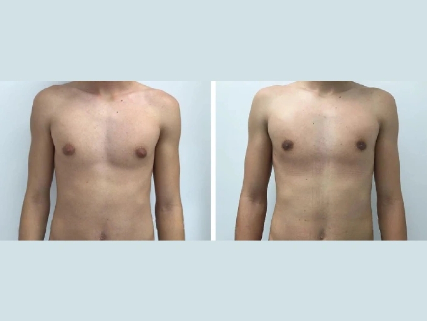 How the Best Gynecomastia Surgeons in Dubai Achieve Consistent Results for Male Breast Reduction